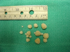 Calcium oxalate bladder stones in dog